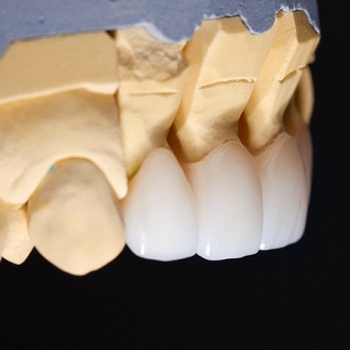 model of porcelain veneers on a mouth