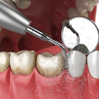 Digital image of a dental cleaning being done