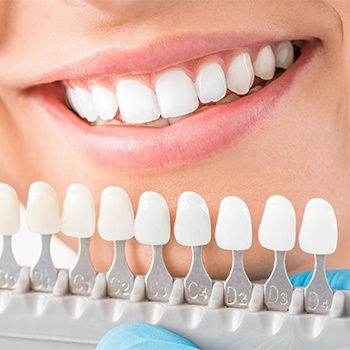 Smile compared with tooth-color chart