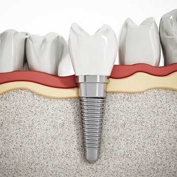 Animation of implant retained dental crown