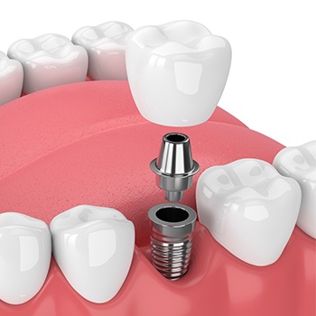 Animation of implant supported dental crown process