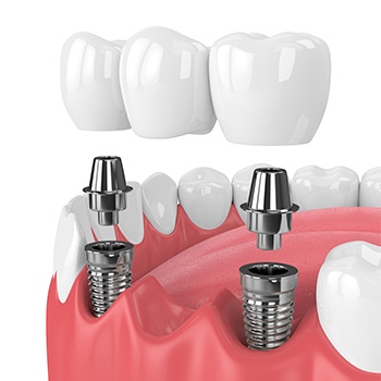 Animation of implant supported fixed bridge process