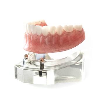 Model smile with implant supported denture