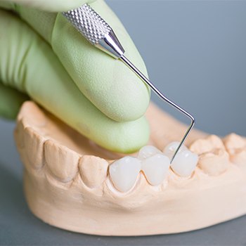 Model smile with fixed bridge restoration