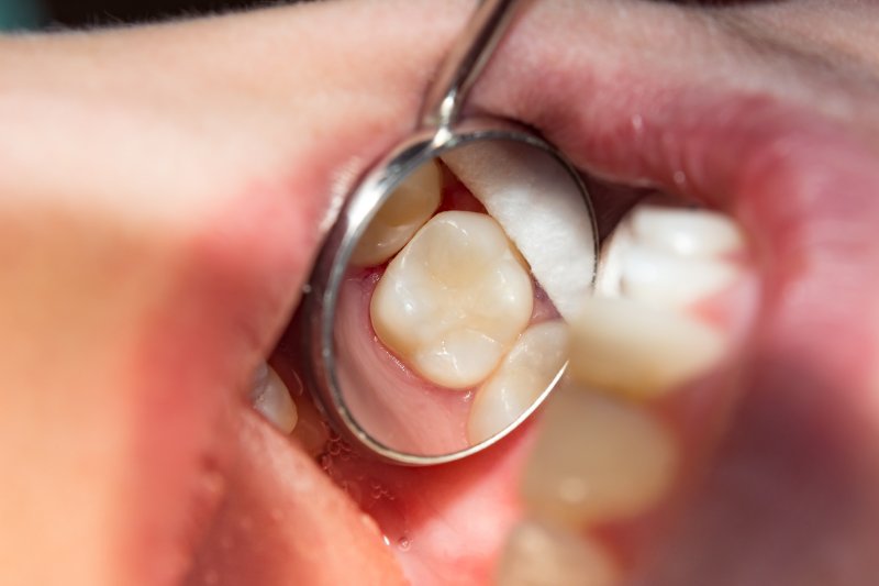 Dental filling